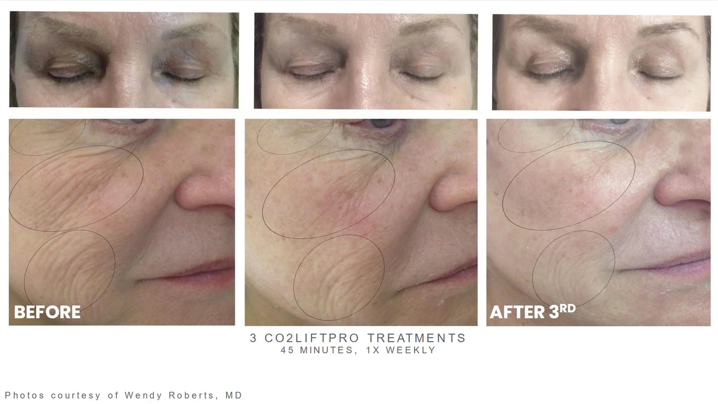 Lumisque CO2Lift® Pro – Topical Carboxy Gel