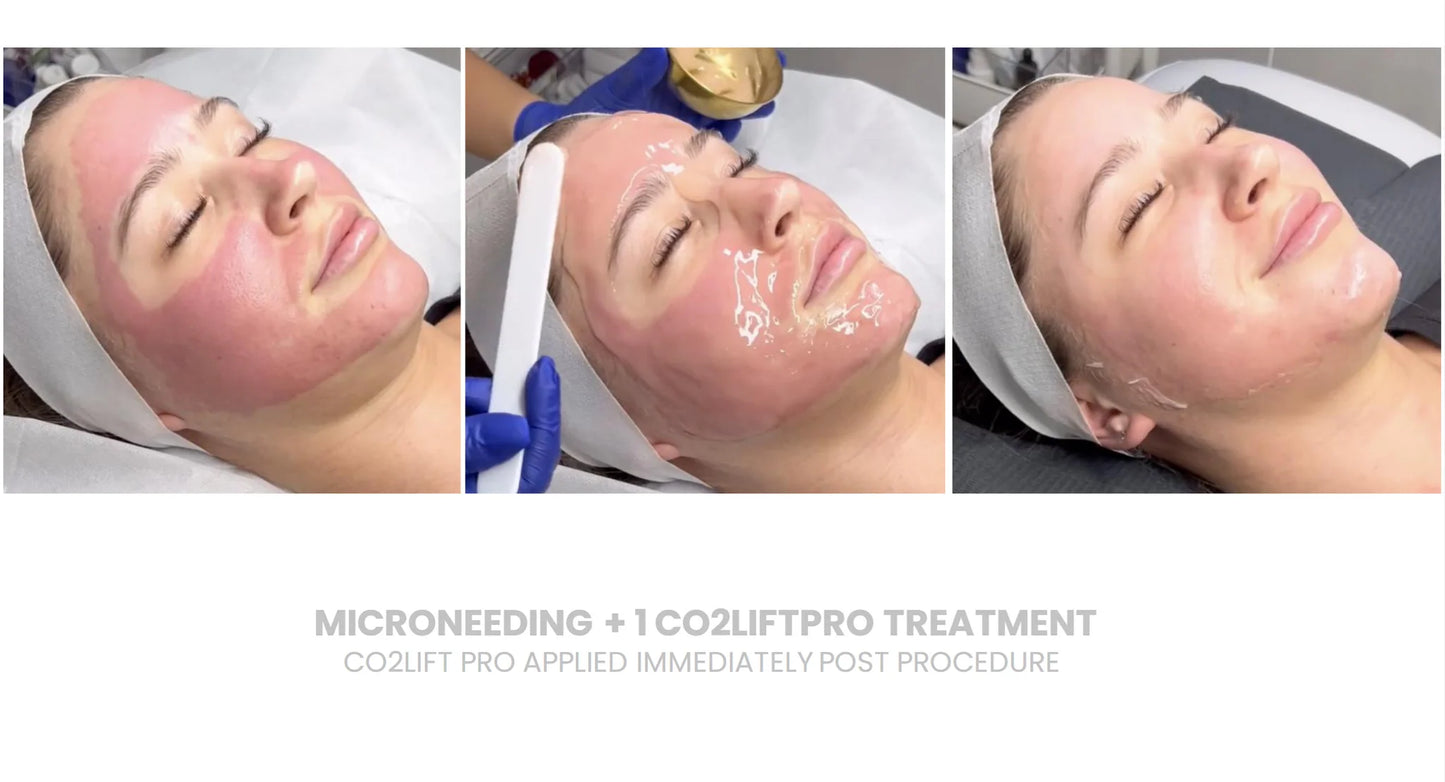 Lumisque CO2Lift® Pro – Topical Carboxy Gel